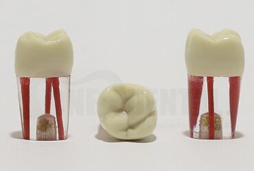 Endo Tooth 16 (3 Canals) for ADC Model(مدل دندان Endo 16 (۳ کانال) برای مدل ADC)