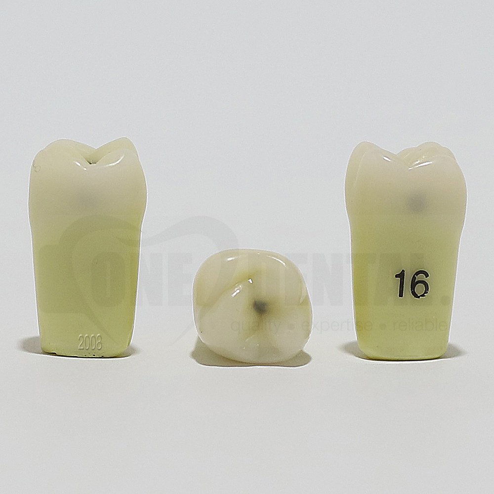 Caries Tooth 16M+O+D for 2008 Adult Model(دندان پوسیده 16M+O+D برای مدل بزرگسال 2008)
