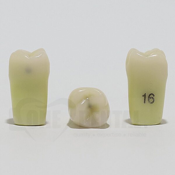 Caries Tooth 16M+O for ADC Model(پوسیدگی دندان ۱۶، سطح مزیال و اکلوزال)