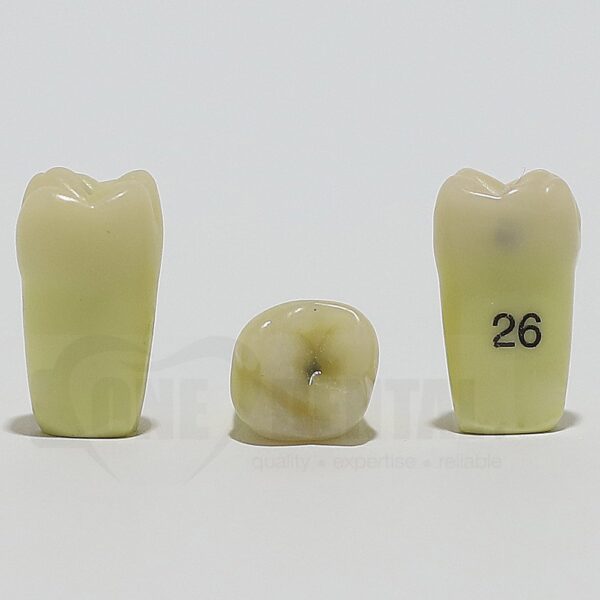 Caries Tooth 26M+O for ADC Model(پوسیدگی دندان شماره ۲۶ (مولر اول فک بالا) در سطوح مزیال (M) و اکلوزال (O))