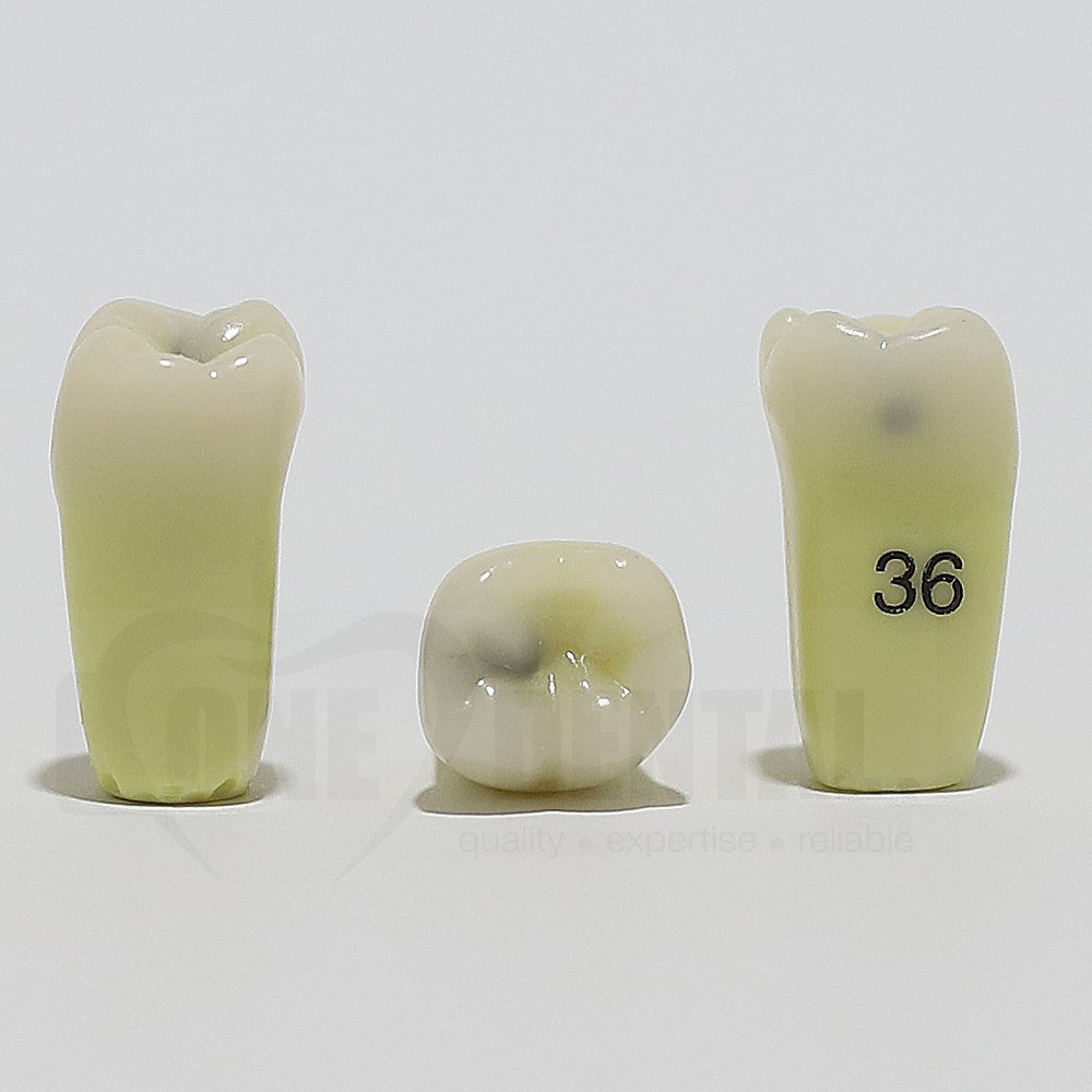 Caries Tooth 36MO for ADC Model(دندان پوسیده 36M+O برای مدل ADC)