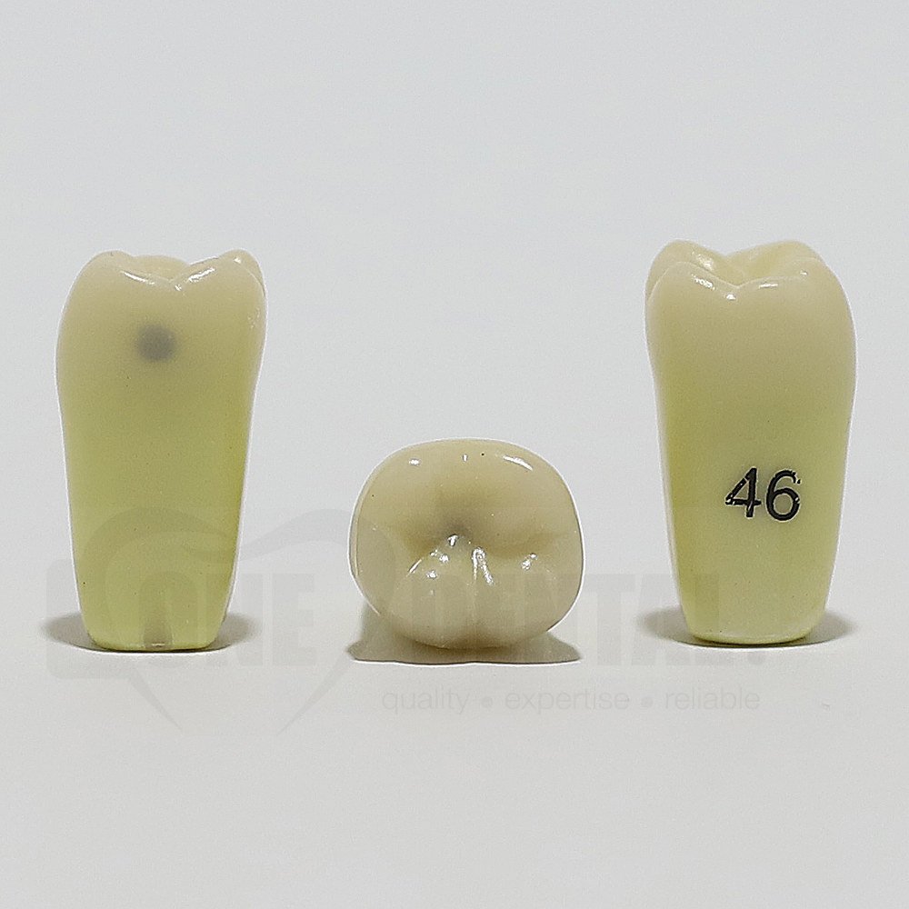 Caries Tooth 46M+O for ADC Model(دندان پوسیده 46M+O برای مدل ADC)